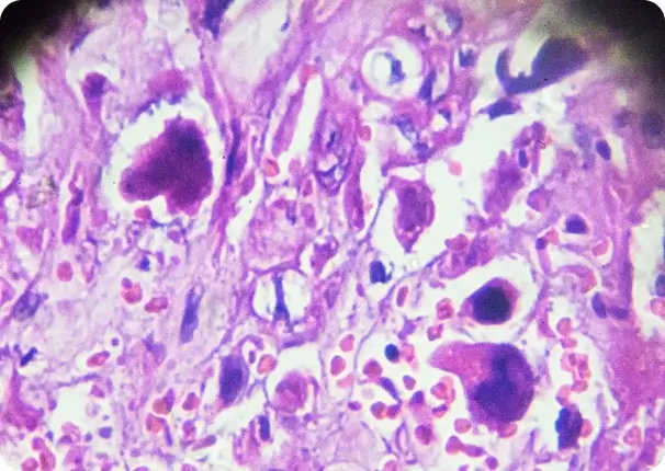 Choriocarcinoma